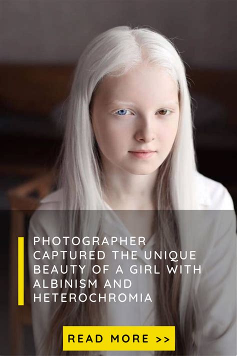 Photographer Captured The Unique Beauty Of A Girl With Albinism And Heterochromia Beauty Girl