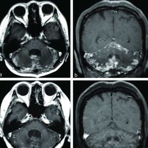 Magnetic Resonance Imaging Images A B T1 Weighted Gadolinium Enhanced