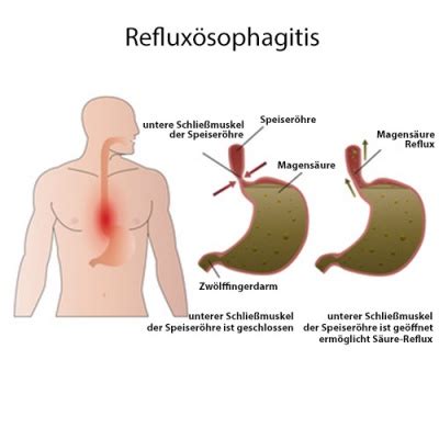 Refluxkrankheit Ursachen Symptome Behandlung Medlexi De