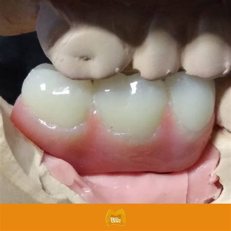 ZIRCONIA IMPLANT BRIDGE (3 UNITS) – Dental Digital Crown