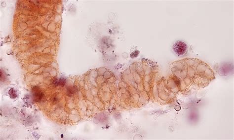 Urine Sediment Of The Month Fibrin Casts In Urine Microscopy Renal