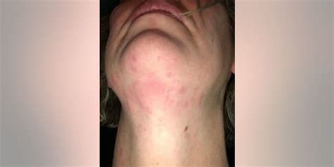 Woman claims allergic reaction to vape caused painful rash, required ...