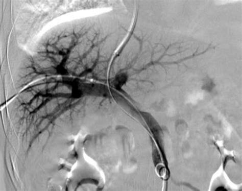 During The Percutaneous Transhepatic Portal Vein Cannulation Assisted