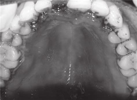 Mandibular Lingual Gingiva Showing Enlargement And Necrosis Download