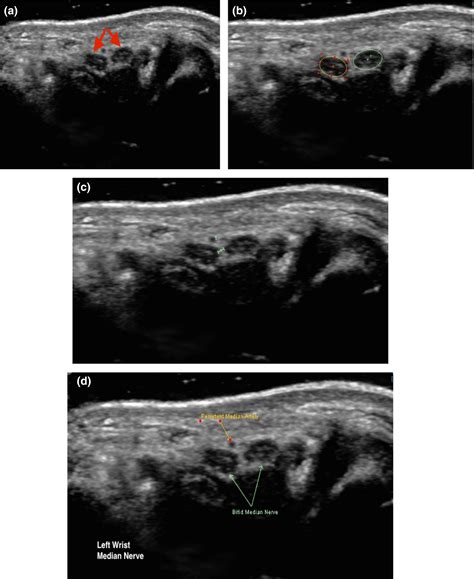 Bifid Median Nerve Ultrasound