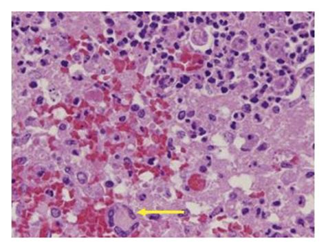 Microphotographs Of Autopsy Brain Sections Hematoxylin And Eosin