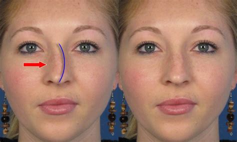 Crooked Nose Before And After Rhinoplasty Nose Surgery Photos