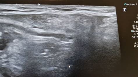 My Indirect Reducible Fat Containing Inguinal Hernia Rradiology