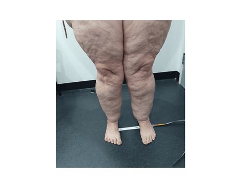 Lipoedema Surgery Case 10 Lipoedema Surgical Solution