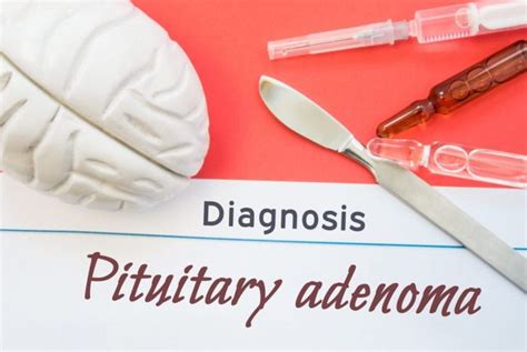 Symptoms and Treatments of Pituitary Tumors - Health & Detox & Vitamins