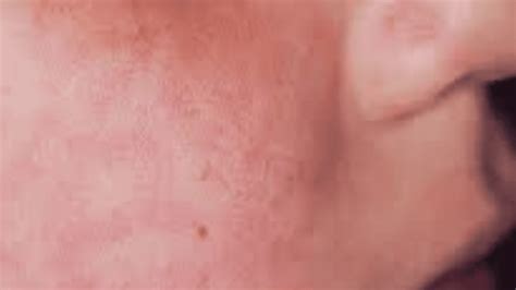 Hiv Skin Rash Qeqe