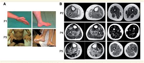 Figure From Agrin Mutations Lead To A Congenital Myasthenic Syndrome