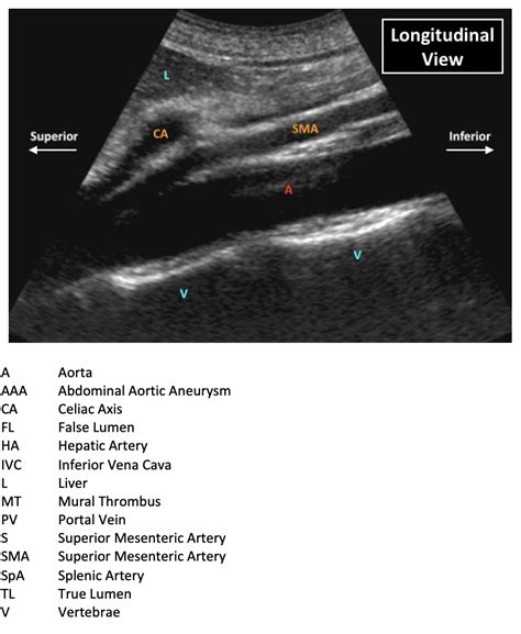 Ultrasound Of The Abdominal Aorta | EMcyclopedia