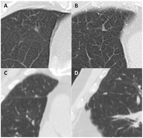 Figure 1 from Clinical significance of perifissural nodules in the oncologic population ...