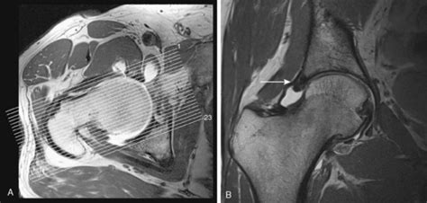 Hip Mri