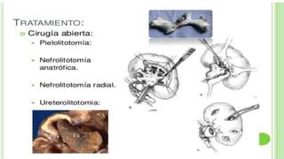 Enfermedades del riñon PPT