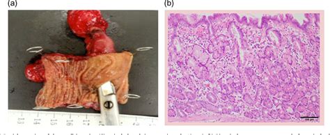 Figure From Single Incision Laparoscopic Surgery Sils For Meckels