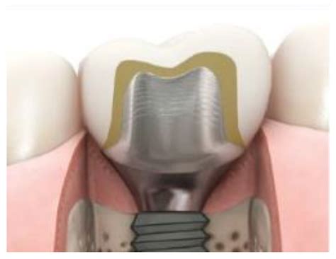 Polymers Free Full Text Behaviour Of The Peri Implant Soft Tissue With Different