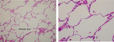 Emphysema Histology