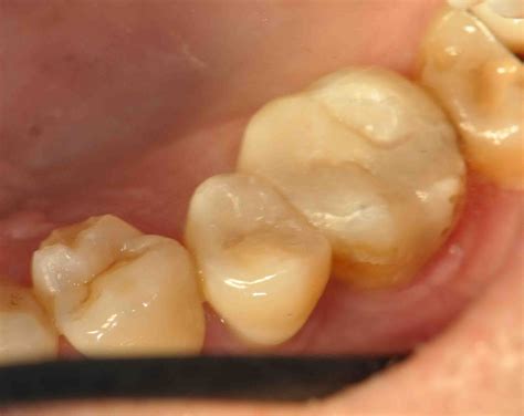 Treatment Options: Dental Aesthetic with White Filling II (On Back Teeth)