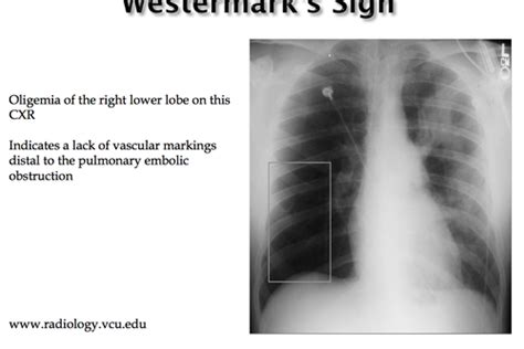 Pulmonary Circulation Disorders Flashcards Quizlet