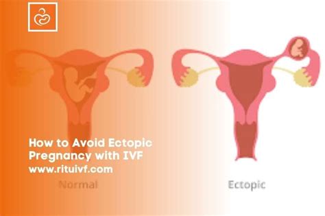 How To Avoid Ectopic Pregnancy With Ivf Ritu Ivf