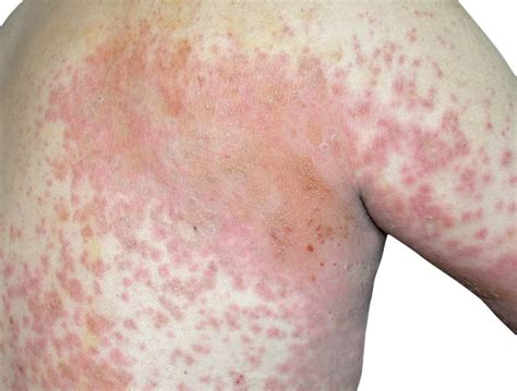 Maculopapular Rash Hiv