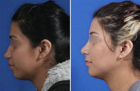 Rhinoplasty Austin Tx Dr Weinfeld