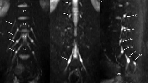 腰骶丛磁共振神经成像mr Neurography Of The Lumbosacral Plexus序列