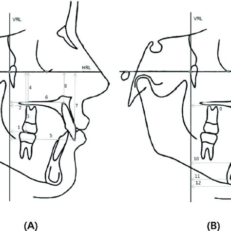 Angular Measurements 1 Maxillary First Molar To Fh Plane Angle 2 Download Scientific