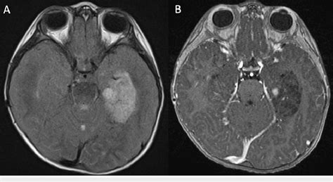 Axial MRI demonstrating left temporal and cerebellar vermis lesions... | Download Scientific Diagram