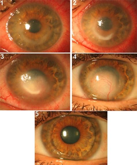 Acanthamoeba Keratitis Ring Infiltrate