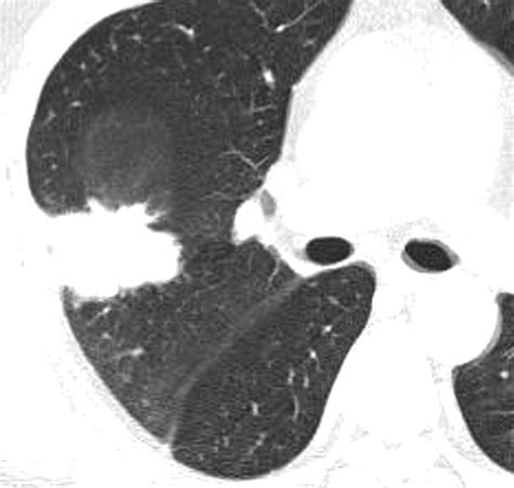 Eosinophilic Lung Diseases A Clinical Radiologic And Pathologic