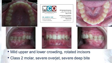 Invisalign Before And After Overjet