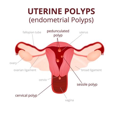 Fibroids vs. Polyps: What's the Difference? | New York City | 1 Fibroid ...