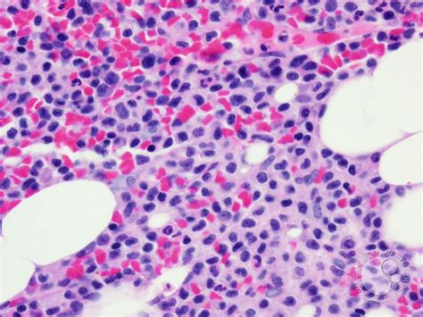 Hairy cell leukemia - 3.