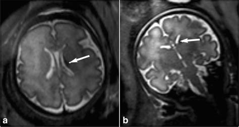 Grade Germinal Matrix Haemorrhage In A Weeks Gestational Age