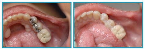 Composite Fillings Scarsdale Ny Scarsdale Dental Group