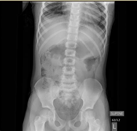 Intussusception In A Year Old Critical Care Sonography