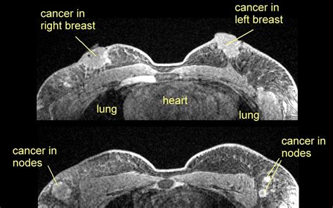 An elderly man with a 3 cm cancer in his left breast