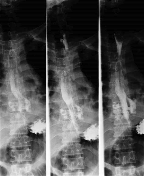 Barium Esophagogram Demonstrating Bilateral Perforations In The Lower