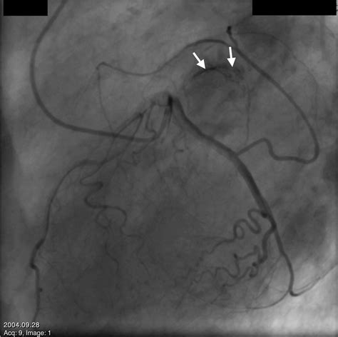 Noninvasive Characterization Of Left Atrial Mass Circulation