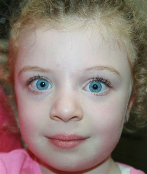 New York Eyelid Hemangioma Treatment Before And After Photos