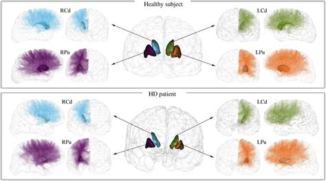 Cortico Striatal Fibre Tracts In One Healthy Subject And One Hd