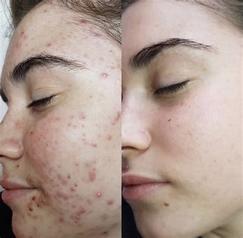 Acne Litteken Behandeling Hoe Kom Ik Van Acne Littekens Af