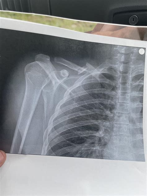 Will this heal w/o surgery? (Broken clavicle) : r/brokenbones