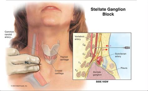 Stellate Ganglion Block For Treating Hot Flashes A Viable Treatment