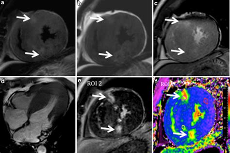 Asymmetric Hypertrophic Cardiomyopathy In A Years Old Man Showed