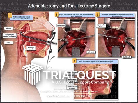 Tonsillectomy Anatomy