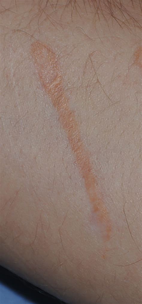 scar revision treatment bellevue seattle
